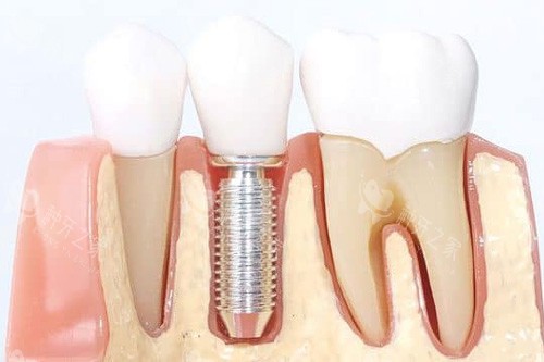 比多亚种植体优缺点一目了然！质量靠谱+体验感超赞