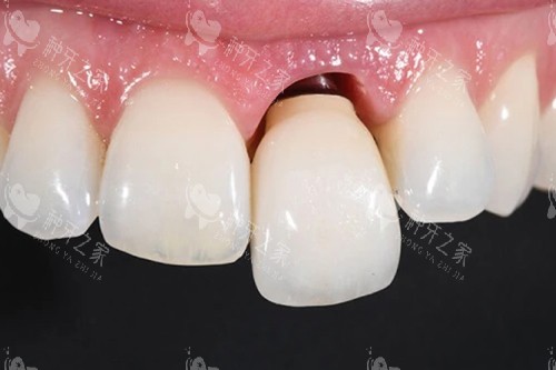 意大利易植种植牙怎么样？质量靠谱还耐用！