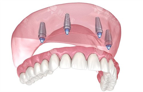 种植牙动画示意图片