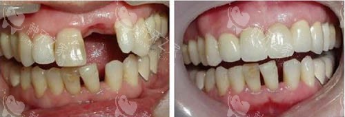 种植牙手术前后图