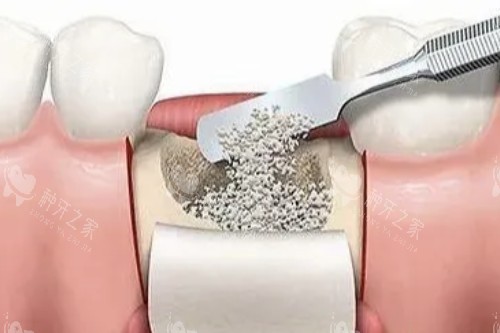 种植牙植骨图片展示 种植牙植骨图片展示