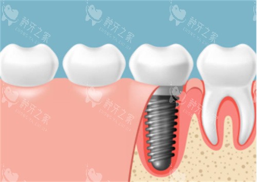 种植牙在口腔剖面图