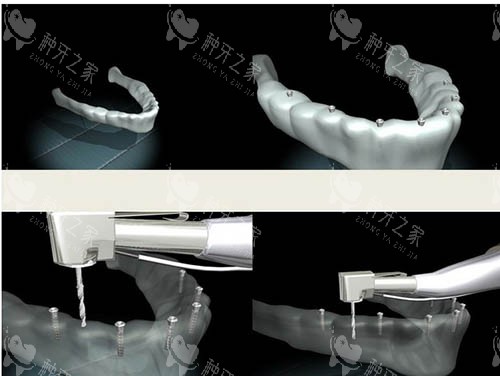 种植牙模拟步骤图 种植牙模拟步骤图