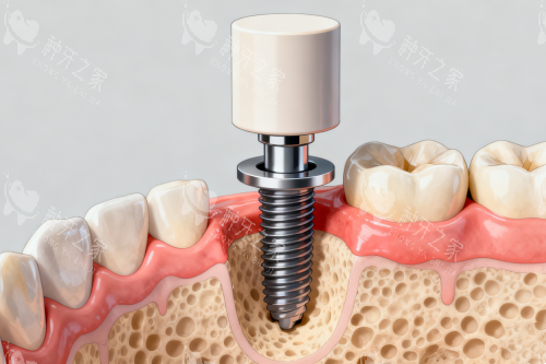 种植牙植入口腔卡通展示图 种植牙植入口腔卡通展示图
