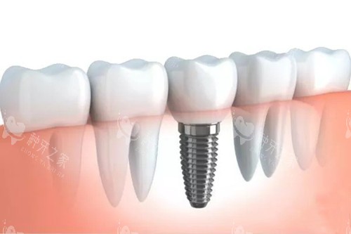 种植牙卡通图片 种植牙卡通图片