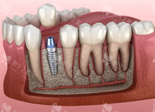 种植牙解剖模型 种植牙解剖模型