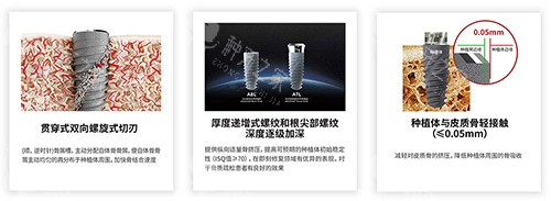 卡尔斯种植牙有什么不同