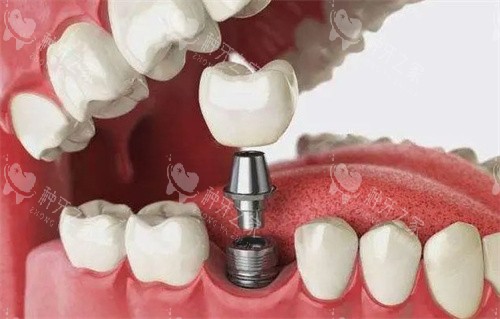 长汀县牙科价格表：种植1880+矫正5000+！