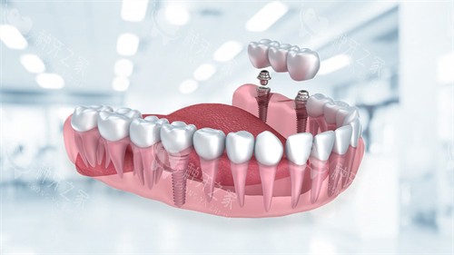 泰科种植牙是杂牌吗？质量扎实+优缺点干货