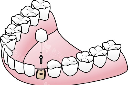 种植牙安装牙冠卡通图