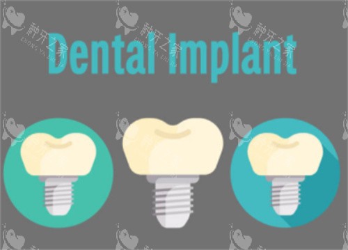 种植牙英文 种植牙英文