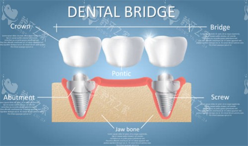 种植体SLA是什么意思?这种表面处理真的更好吗?