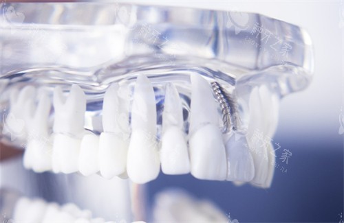 上海优牙口腔种植牙地址电话，在线预约种植牙