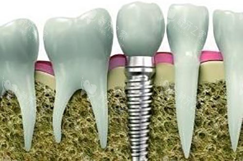 种植牙和真牙牙根对比示意图 种植牙和真牙牙根对比示意图