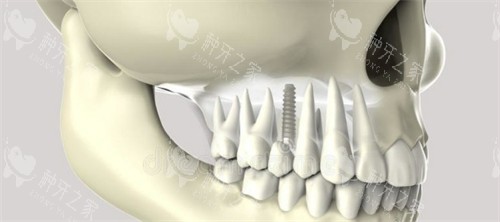 登腾种植体是什么档次？中端性价比王者！