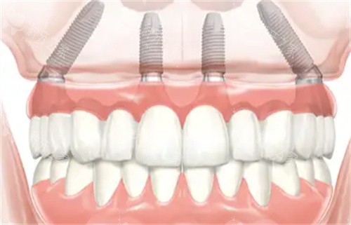 奥齿泰种植牙的优点和缺点全解析！四级纯钛材质超耐用