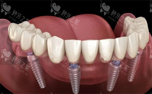 汇总!4位网友做半口全口种植牙6年后的100字感受