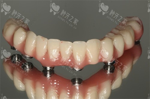 全口种植牙下颌