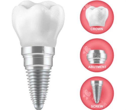 种植牙的三部分