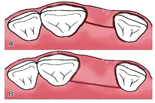 韩国纽百特种植体怎么样？耐磨抗造+性价比拉满