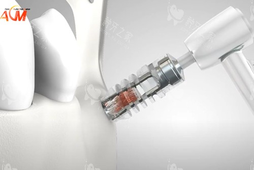 德国ACM种植牙示意图