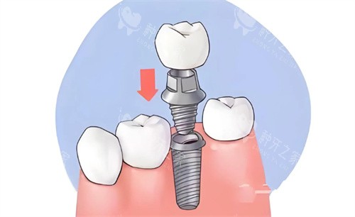 种植牙手术动画示意图 种植牙手术动画示意图