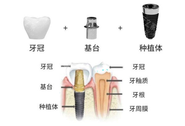 可恩口腔种植牙价格表！含单颗全口种植价格费用清单！