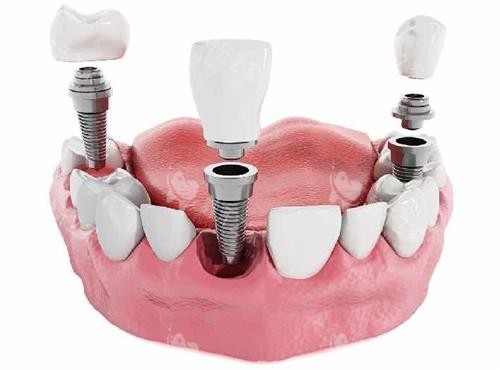 韩国sg种植体质量如何？使用感超棒，靠谱不踩雷