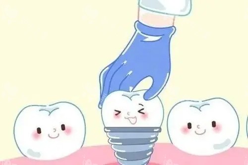 种植牙安装卡通示意图 种植牙安装卡通示意图