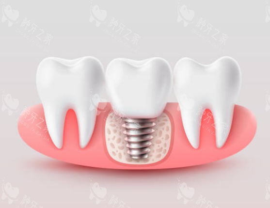 德国ACM种植牙价格表曝光：3000元起差异大