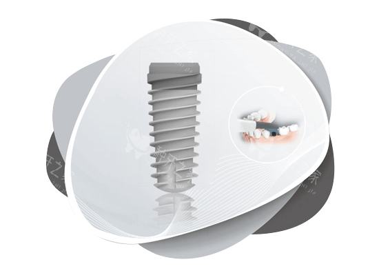 德国种植牙品牌及价格揭秘：材质/工艺与收费的关联