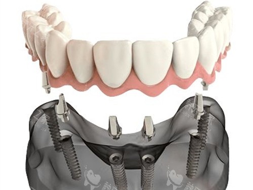 半口种植牙联排牙冠安装示意图