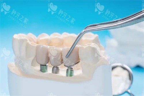 内江种植牙多少钱一颗？国产和进口哪个更划算？