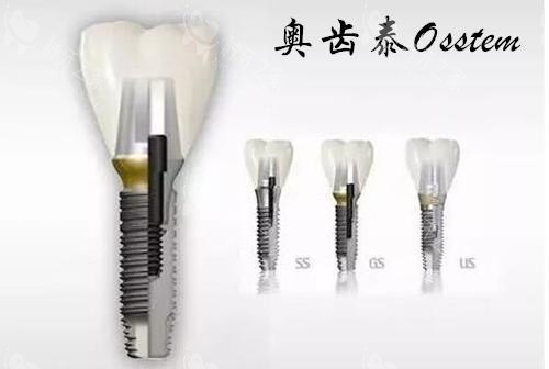 安科罗斯种植牙适合谁？单颗/多颗/全口缺牙适配指南