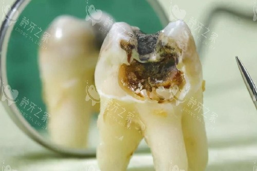 牙齿从根部开始烂图片