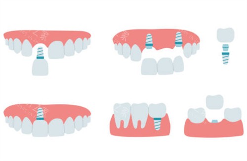 牙齿缺失种植牙示意图