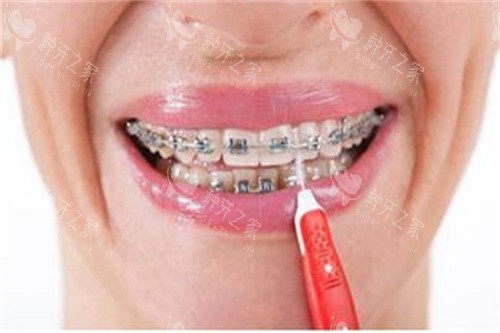 正在做正畸的牙齿宣传图