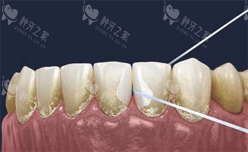 牙线清理牙齿缝隙