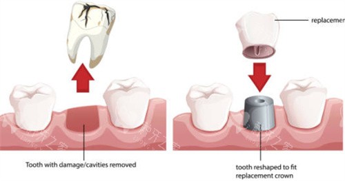 种植牙拔牙和戴冠图