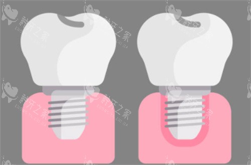 沃兰种植体和奥齿泰哪个好？按需选更适配种植体！