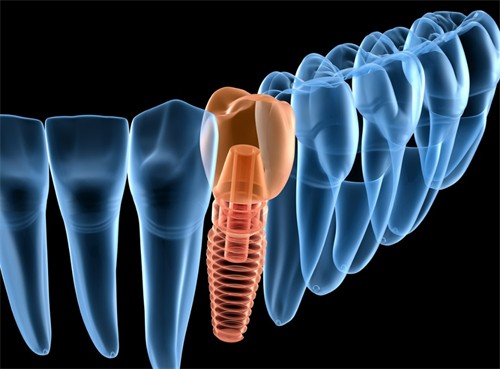枣庄种牙价格是多少？2025枣庄各品牌种牙价格