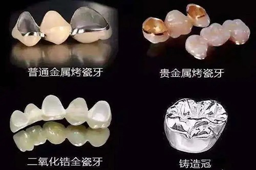 儋州种牙多少钱？国产进口种牙5200+