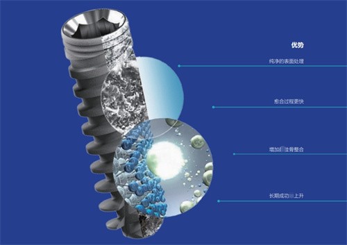 丹特因和雅定植体有什么区别？五方面精细对比可知晓