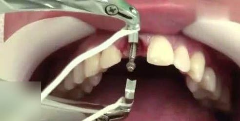 保山种一颗门牙要多少钱？不同档次价格一览