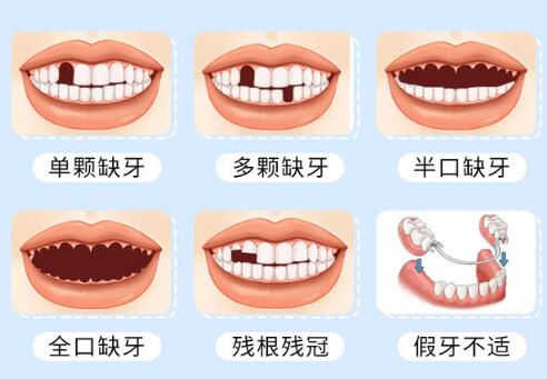 需要做牙齿种植的类型卡通图介绍