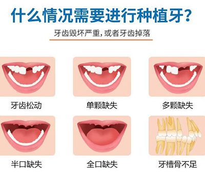 牙齿出现哪种情况需要种植