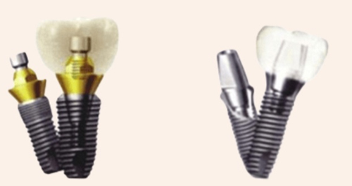 韩国登腾dentium种植牙2023价格表已汇总！