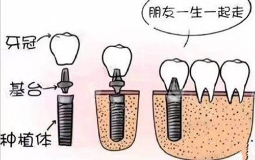 种植牙结构