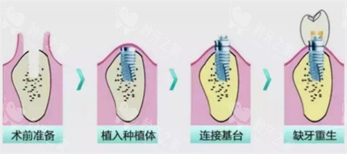 种植牙过程图解