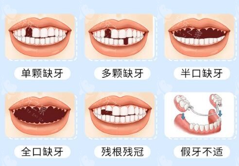 长沙美奥口腔医院种植牙价格表！2380元起！